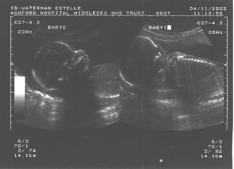 22 wk scan